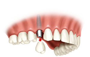 Методы восстановления утраченых зубов