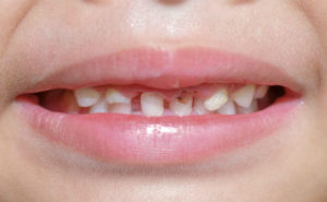 CHem opasny nevylechennye molochnye zuby dlya detej