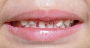 CHem opasny nevylechennye molochnye zuby dlya detej
