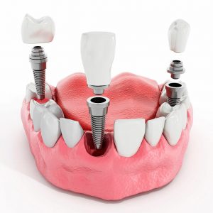 metodiki implantatsii zubov